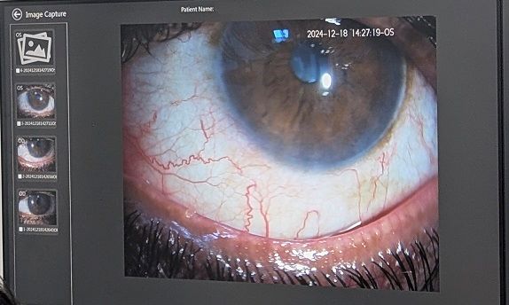 Dry eye treatment at MCVI